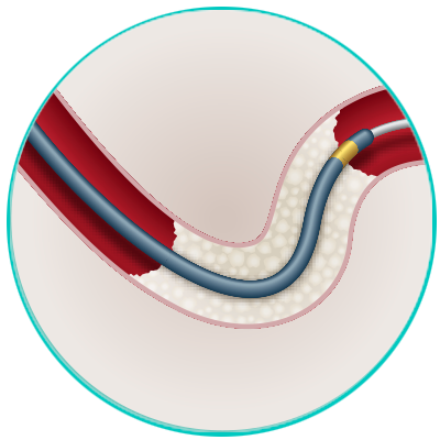 Microcateteres Coronarios - Finecross